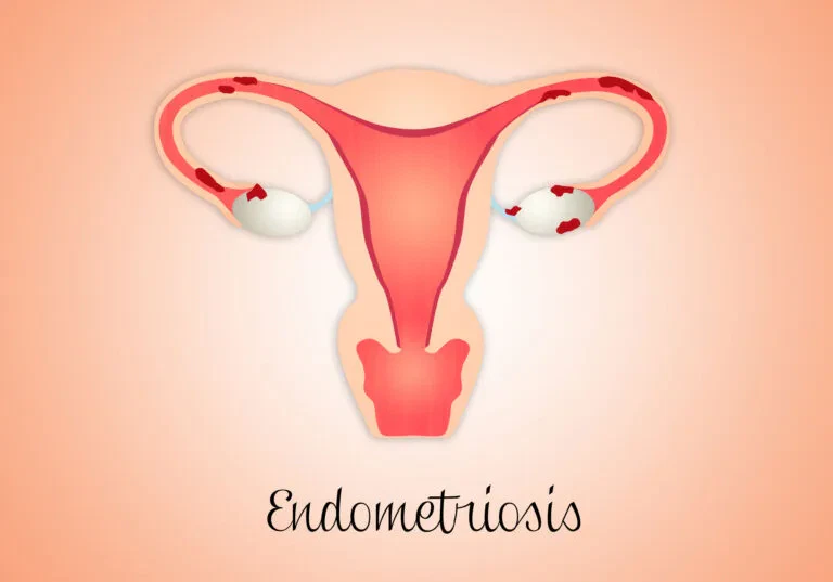 Endometriosis image