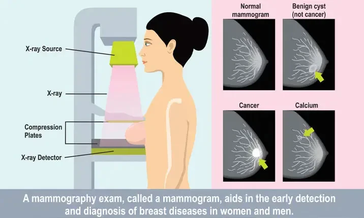 Breast Cancer Mammogram